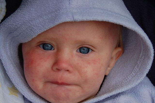 Is measles what Chickenpox vs.